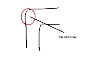 2 Knie Arthrose Studien Langzeit -Traktion Erfolge! 1 Knie mit Arthrose