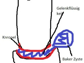 Baker Zyste Kniegelenk