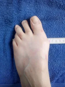 Hallux Valgus linker Fuß einer Frau