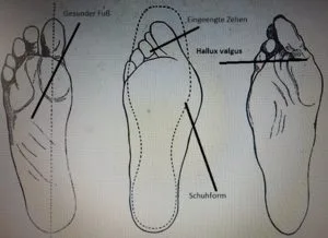 Hallux valgus Zeichnung