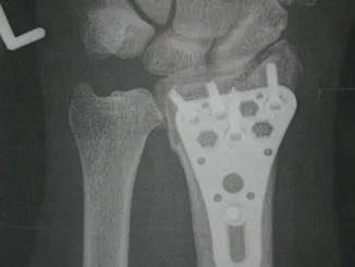 Video Nachweis Arthrose Heilen ! 5 Handgelenk Bruch Knorpel Defekt Arthrose