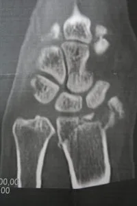 Trümmerbruch Handgelenk Arthrose