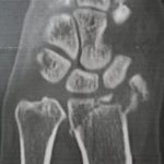 Trümmerbruch Handgelenk Arthrose