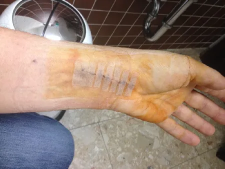 Operation Handgelenk nach Trümmerbruch. Arthrose Handgelenk nach Bruch Operation