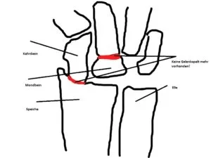 Handgelenk Arthrose